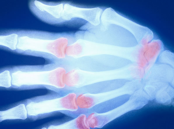 Röntgenaufnahme einer Hand mit roten Markierungen für entzündete Stellen durch z.B. Rheumatoide Arthritis